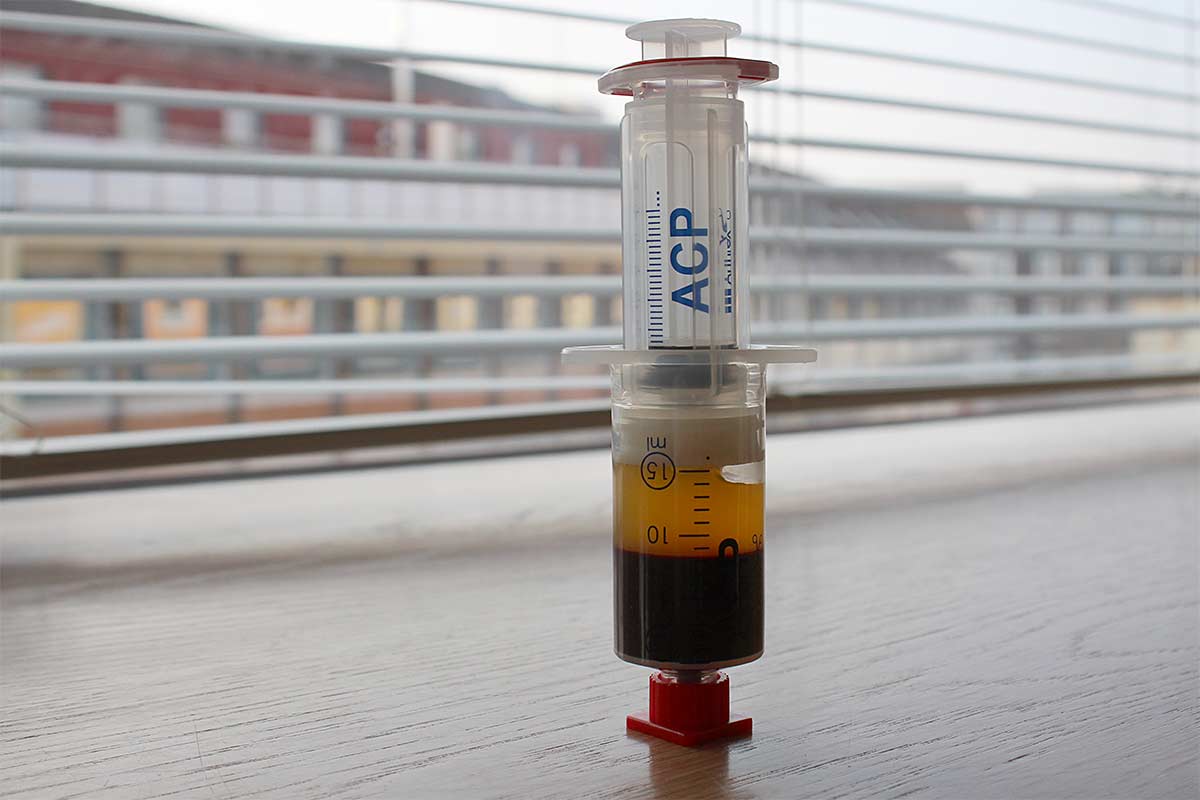 Autologous Conditional Plasma (ACP) Vorschau